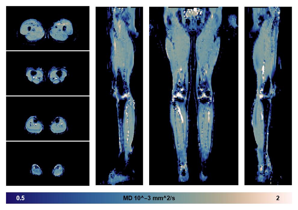 IVIM corrected whole leg muscle mean diffusivity obtained from diffusion tensor imaging.